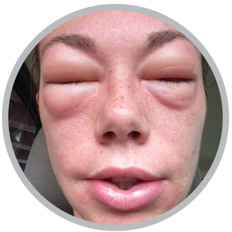 hsc - NSFA - allergies