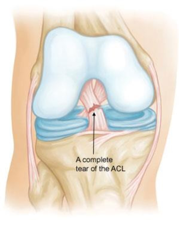 ACL, anterior cruciate ligament (ACL)., glasgow ph