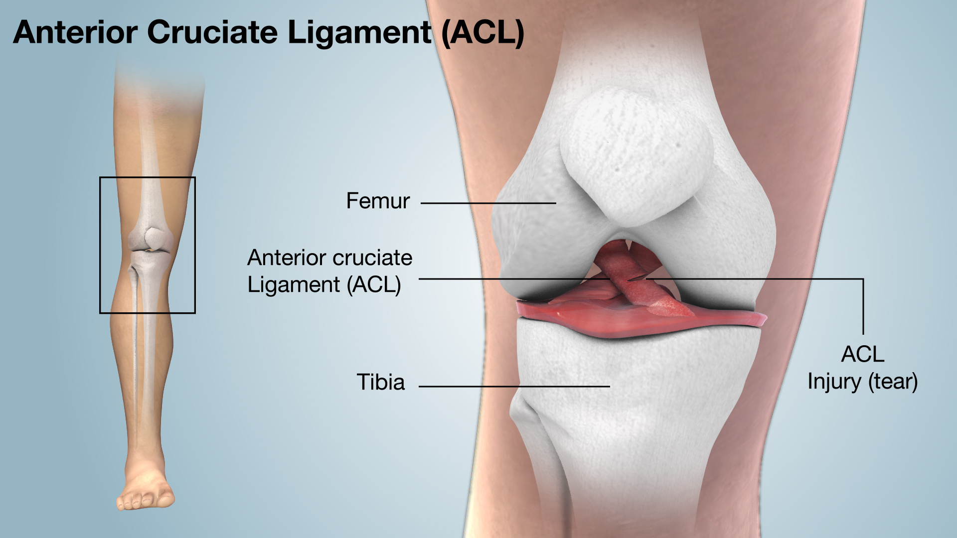 Hampden Sports Clinic, Physio for Women, Women Physio, Womens Health,  Healthy Women, Women in Sport, ACL injury, ACL, Knee Injury, knee rehab, post surgical rehab